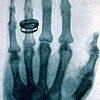 Erstes Röntgenfoto